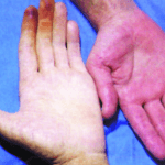 مرض الثالول وعلاجه بالثوم