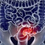 طرق الوقاية من القولون الأميبي