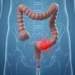 طرق علاج القولون المخاطي