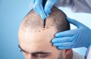 مركز زراعة الشعر في اسطنبول