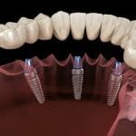 ابتسامة بلا حدود، أسعار تلائم الجميع – اكتشف تكلفة زراعة الأسنان في مصر! زراعة الأسنان في تركيا في مركز إيلورا