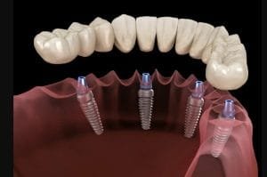 زراعة الأسنان في تركيا في مركز إيلورا