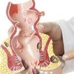 علاج البواسير